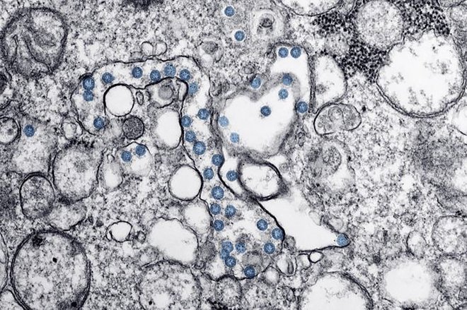 Mikroskopska povečava prve okužbe z boleznijo covid-19 v ZDA. FOTO: AFP