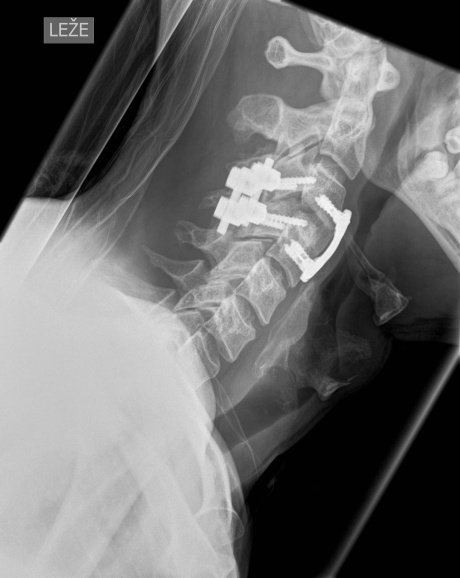 Slika mladega moškega s poškodbo vratne hrbtenice in tetraplegijo. Skočil je v pol metra globoko vodo. FOTO: UKC Ljubljana