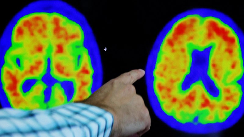 Fotografija: Možgani bolnika z Alzheimerjevo boleznijo. FOTO: Brian Snyder/Reuters