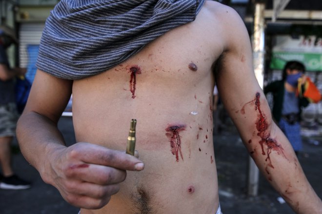 Protestnik kaže rane od gumijastih nabojev, ki jih uporabljata policija in vojska v spopadih z demonstranti v čilski prestolnici Santiago. FOTO: Javier Torres/AFP