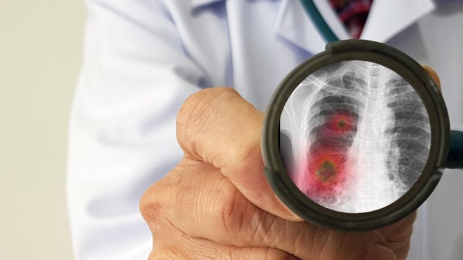 Morebitne bolnike z novim koronavirusom z območja Gorenjske bodo sprejemali v Univerzitetni kliniki za pljučne bolezni in alergijo Golnik. FOTO: Shutterstock