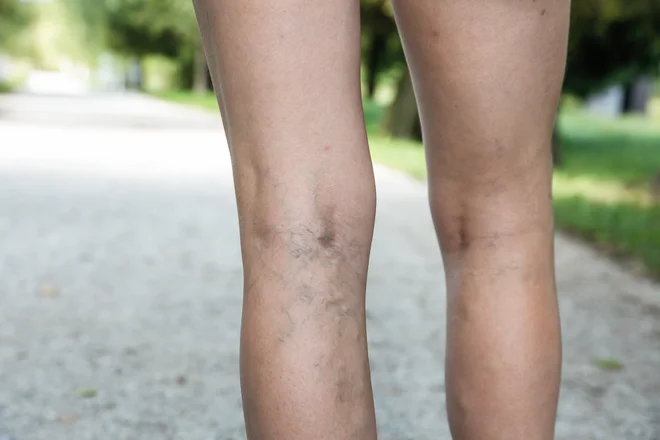 Arterijske anevrizme so žilne izbokline, ki so &raquo;potrjene&laquo;, ko se arterija poveča za polovico. Foto: Shutterstock