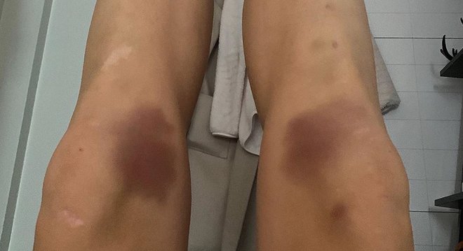 »Ali imajo vsi biatlonci takšna kolena?« se sprašuje Stina Nilsson. FOTO: Instagram