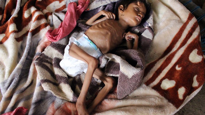 Fotografija: Salwa Ibrahim, petletna deklica, ki trpi zaradi akutne podhranjenosti, saj je težka lvsega tri kilograme, spi na postelji v improvizirani hiši v jemenski provinci Hajjah. Zdravstveni sistem države se razpada že odkar je leta 2014 izbruhnila vojna. Več kot dve tretjini,približno 24 milijonov prebivalcev, potrebuje pomoč za preživetje. FOTO: Essa Ahmed/Afp