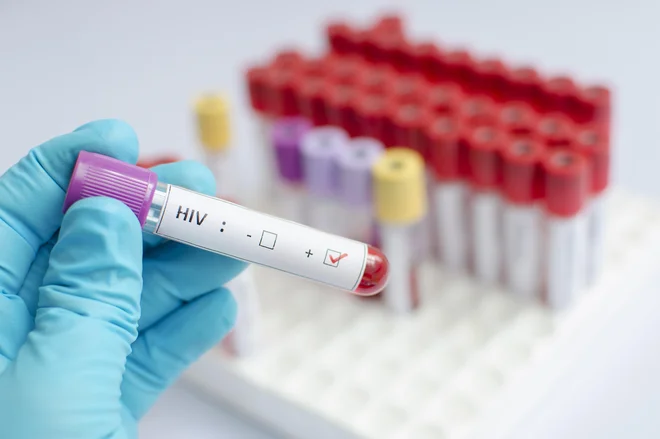 Osebe, ki živijo s hiv, še vedno doživljajo diskriminacijo. FOTO: Getty Images/istockphoto