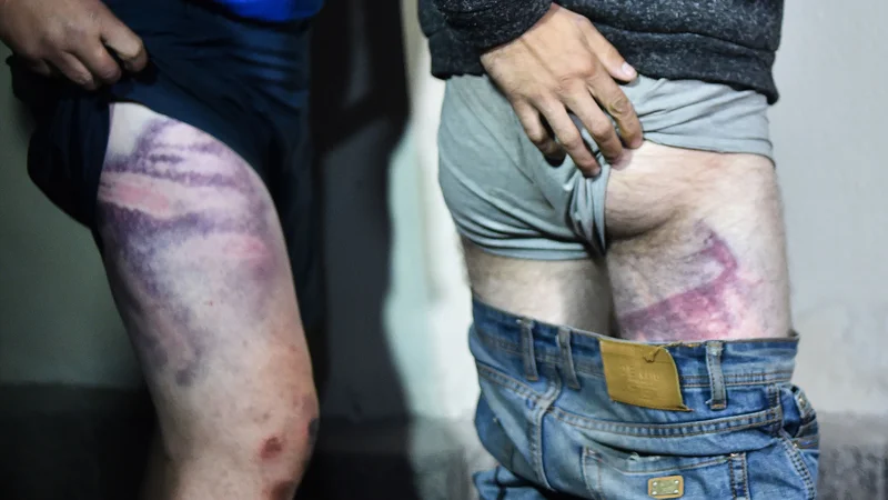 Fotografija: Beloruski podporniki opozicije, ki jih je policija aretirala na protivladnih shodih, kažejo na lastni koži sledi policijske brutalnosti, ko so bili zgodaj zjutraj izpuščeni iz zapora v Minsku. V beloruski prestolnici se je znova zbralo več deset tisoč protestnikov, ki zahtevajo Lukašenkov odhod in konec policijskega nasilja. Medtem ko se v medijih in na družbenih omrežjih vrstijo poročila o prekomerni uporabi sile zoper demonstrante in pridržane, protestniki vztrajajo na ulicah. FOTO: Sergei Gapon/Afp