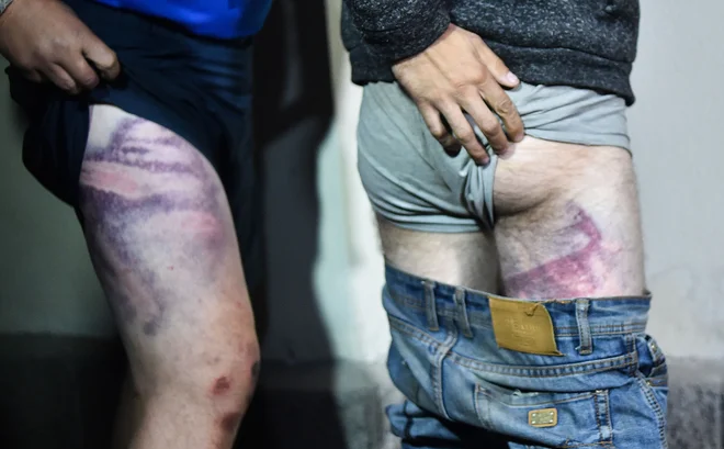 Beloruski podporniki opozicije, ki jih je policija aretirala na protivladnih shodih, kažejo na lastni koži sledi policijske brutalnosti, ko so bili zgodaj zjutraj izpuščeni iz zapora v Minsku. V beloruski prestolnici se je znova zbralo več deset tisoč protestnikov, ki zahtevajo Lukašenkov odhod in konec policijskega nasilja. Medtem ko se v medijih in na družbenih omrežjih vrstijo poročila o prekomerni uporabi sile zoper demonstrante in pridržane, protestniki vztrajajo na ulicah. FOTO: Sergei Gapon/Afp