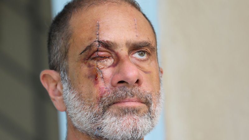 Fotografija: Portret 59-letnega libanonskega psihoterapevta Ronyja Mecattafa, ki je v eksploziji v Bejrutu 4. avgusta izgubil desno oko. Močna eksplozija, ki je ubila 177 ljudi in na tisoče ranjenih, večinoma zaradi letečih koščkov stekla. Vsaj 400 ljudi je utrpelo poškodbe očesa, več kot 50 je bilo potrebnih operativnih posegov, najmanj 15 pa jih je bilo trajno zaslepljeno na eno oko, kažejo podatki, ki so jih pripravile večje bolnišnice v Bejrutu in okolici. Foto Anwar Am/Afp