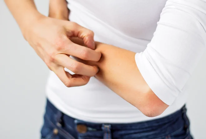 Pridite na brezplačni preventivni pregled za odkrivanje sumljivih sprememb na koži. FOTO: Shutterstock