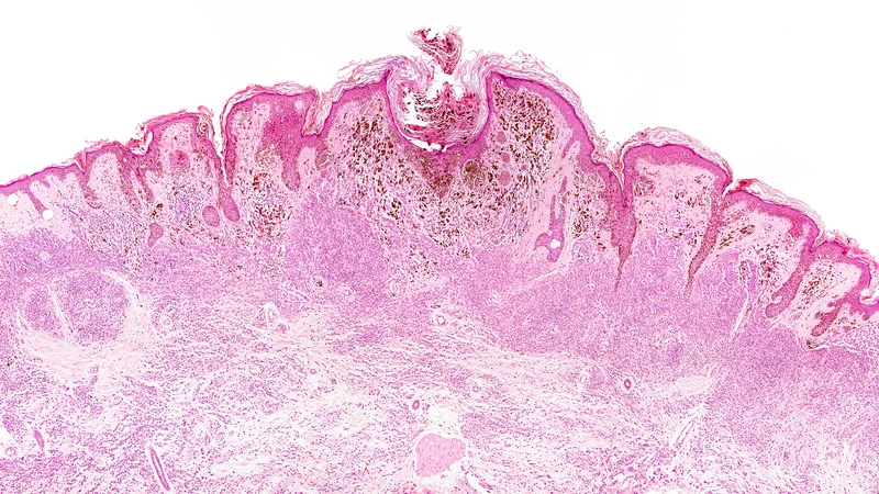 Fotografija: Raziskovalci z IJS so z nanoluskami uspeli skoraj povsem zaustaviti napredovanje melanoma pri miških.