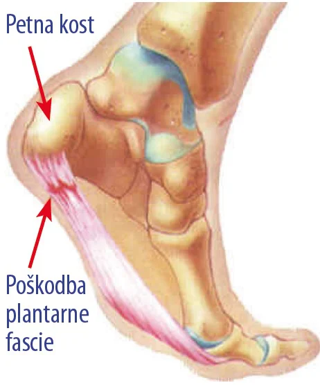 Narastišče plantarne fascije Foto: Artros