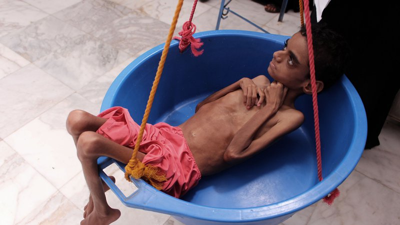 Fotografija: V bolnici v jemenskem mestu Hajjah so sprejeli zelo podhranjenega dečka. Zaradi državljanske vojne se s pomanjkanjem osnovnih življenskih potrebščin sooča več kot polovica prebivalstva. Foto Essa Ahmed Afp