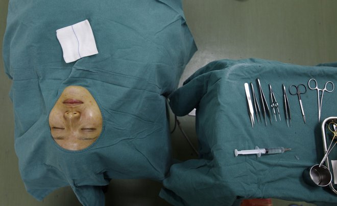 Pacientka Zhang Ding Ling je operacijo dobila za darilo od staršev za 23. rojstni dan. FOTO: Nir Elias/Reuters