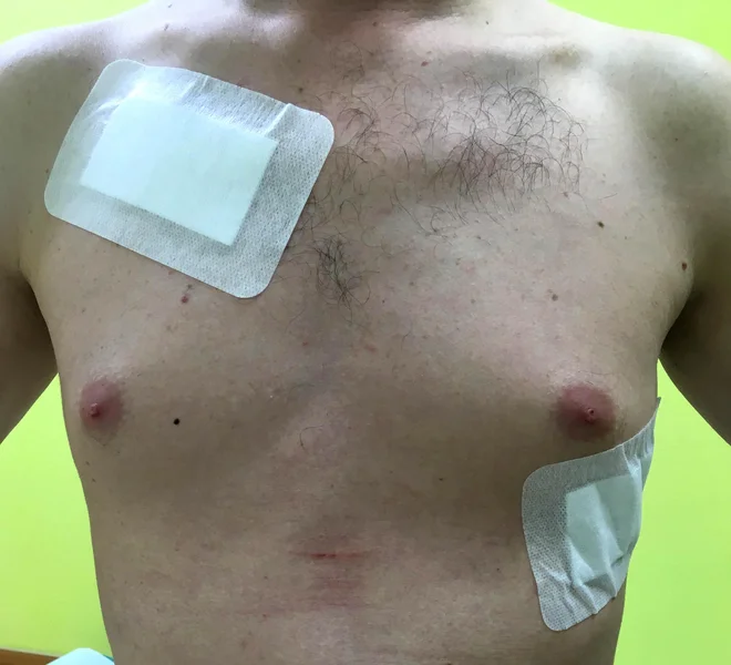 Operiran le z dvema minimalnima rezoma. Foto UKC Ljubljana