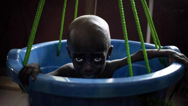 Fotografija: Podhranjena deklica joka med dnevnim kontrolnim tehtanjem na pediatričnem oddelku v Bangui 4. decembra 2018. V Srednjeafriški republiki je umrljivost dojenčkov najvišja na svetu, pri čemer dva od treh otrok ali 1,5 milijona ljudi potrebuje humanitarno pomoč, piše v poročillu UNICEF-a iz leta 2018. Foto Florent Vergnes Afp