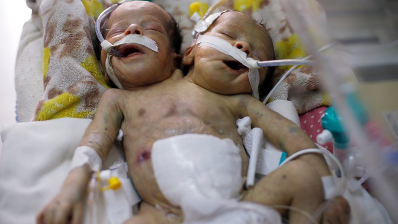 Fotografija: Novorojena dvojčka ležita v inkubatorju na oddelku za intenzivno nego otrok v bolnišnici al-Thawra v Sani. Zdravniki pravijo, da ločevanje dvojčkov ni ustrezna možnost v Jemnu, ker imata dve roki, dve nogi in eno spolovilo. Foto Khaled Abdullah Reuters