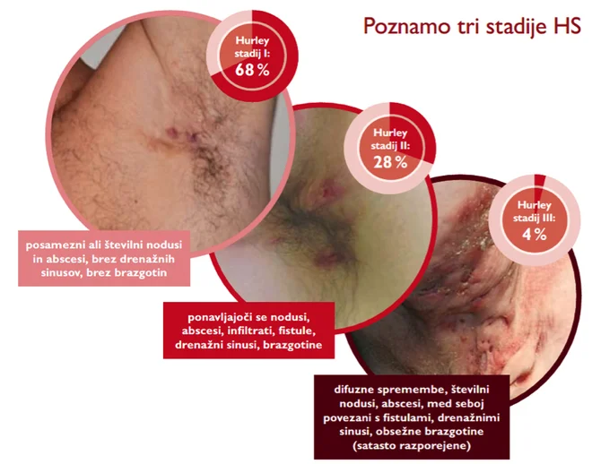 Kožna bolezen HS se razvije v treh stadijih. Foto Arhiv Adrema