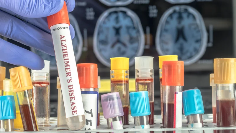 Fotografija: Čimprejšnja diagnoza je pri alzheimerjevi bolezni zelo pomembna, zato so hitrejši načini diagnosticiranja izjemno dobrodošli. Foto Shutterstock