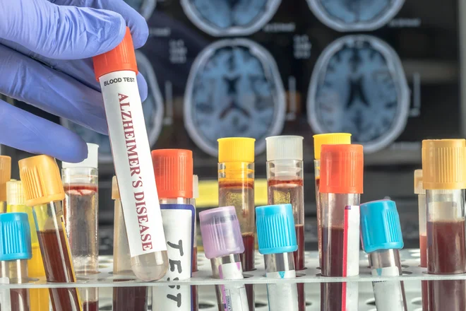 Čimprejšnja diagnoza je pri alzheimerjevi bolezni zelo pomembna, zato so hitrejši načini diagnosticiranja izjemno dobrodošli. Foto Shutterstock