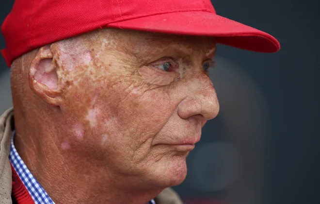 Predlani umrli Niki Lauda je imel od nesreče leta 1976 zaradi opeklin iznakažen obraz. FOTO: Matthew Childs/Reuters