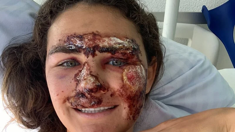 Fotografija: Ameriška alpska smučarka Alice Merryweather si je ob padcu na treningu hudo odgrnila obraz. FOTO: twitter