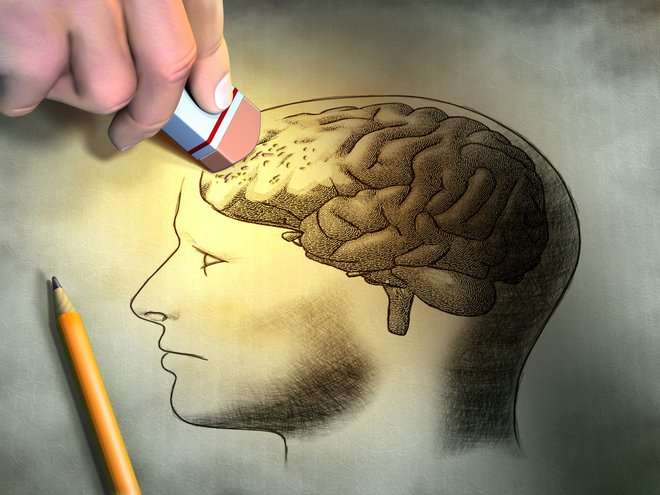 Možgani pri Alzheimerjevi bolezni. FOTO: Shutterstock
