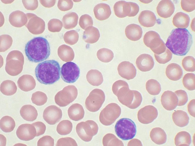 Rakave celice kronične limfocitne levkemije med zdravimi krvnimi celicami. FOTO: Wikimedia Commons
