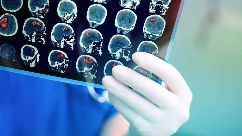 Fotografija: Z metodo diagnostike možganskih tumorjev na podlagi običajnih krvnih preiskav so odkrili tudi zelo majhne tumorje. FOTO: Shutterstock