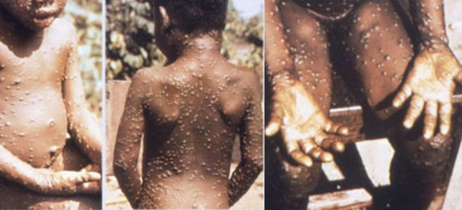 Bolezen, zelo podobna črnim kozam, je v številnih afriških državah endemična. FOTO: Wikipedia
