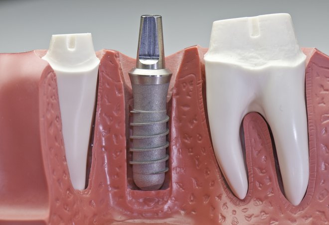 Pri bolnikih, ki so zaradi malignomov izgubili določeno število zob, protetično rešitev na zobnih vsadkih tudi finančno zagotavlja ZZZS. FOTO: Shutterstock