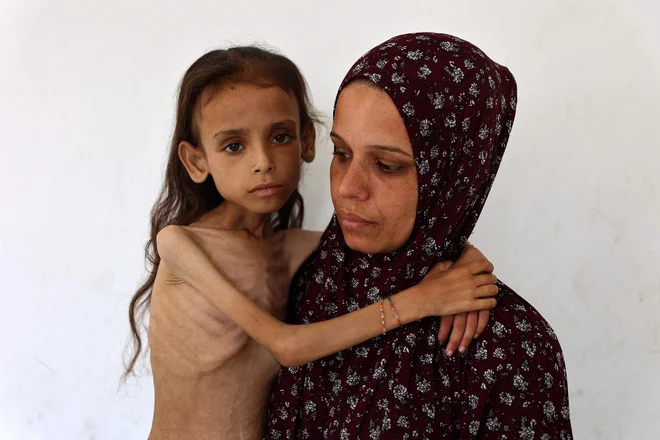 Devetletno podhranjeno palestinsko deklico Mariam Dawwas, ki ni več sposobna sama hoditi, nosi njena mati. 33-letna Modallala, ki z družino živi v taborišču za razseljene osebe na severu Gaze, je povedala, da njena hči ni imela nobene znane bolezni in je pred vojno tehtala 25 kilogramov, zdaj pa je shujšala na 10 kilogramov. Svetovna zdravstvena organizacija je opozorila, da podhranjenost v Gazi dosega zaskrbljujoče ravni. Foto: Omar Al-qattaa/Afp