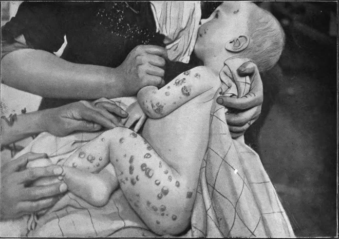 Bromizem je bila v 19. in na začetku 20. stoletja presenetljivo pogosta bolezen. FOTO: Norman Purvis Walker